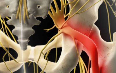 Soulager la sciatique et rester actif tout l’été